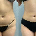 Thumbnail of http://Liposuction%20before%20and%20after