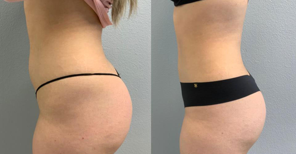 Liposuction before and after side view