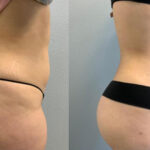 Thumbnail of http://Liposuction%20before%20and%20after%20side%20view