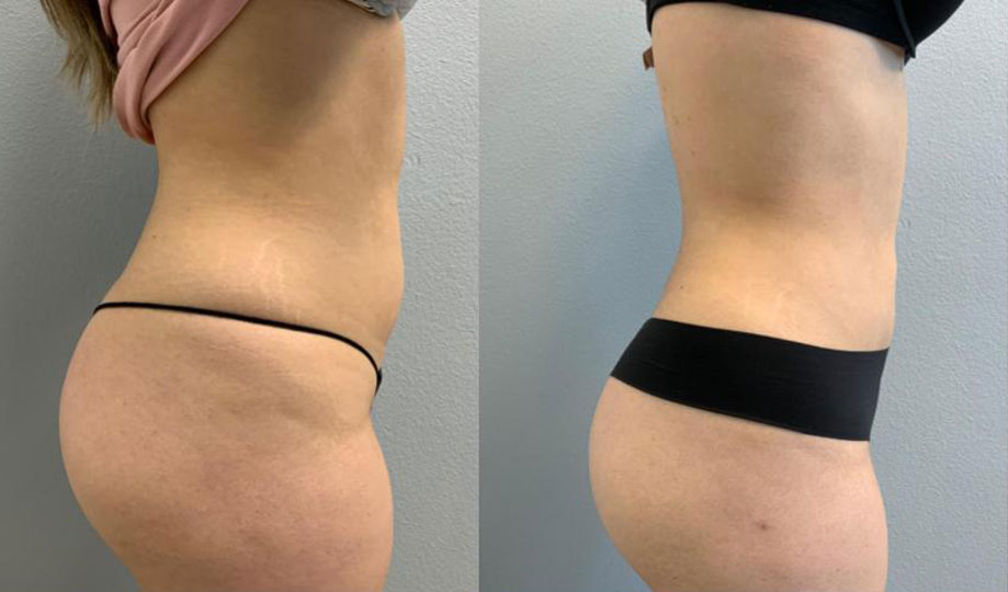 Liposuction before and after side view