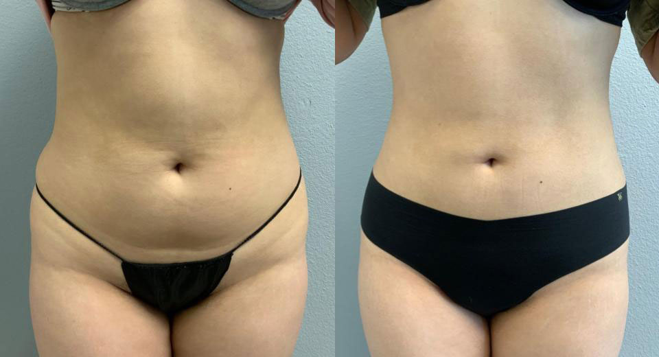 Liposuction before and after