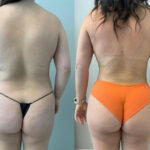 Thumbnail of http://Liposuction%20before%20and%20after