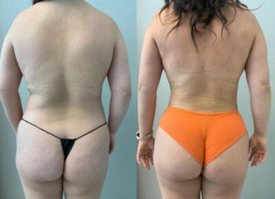Liposuction Patient 2