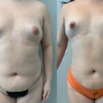 Thumbnail of http://Liposuction%20before%20and%20after%20front%20view