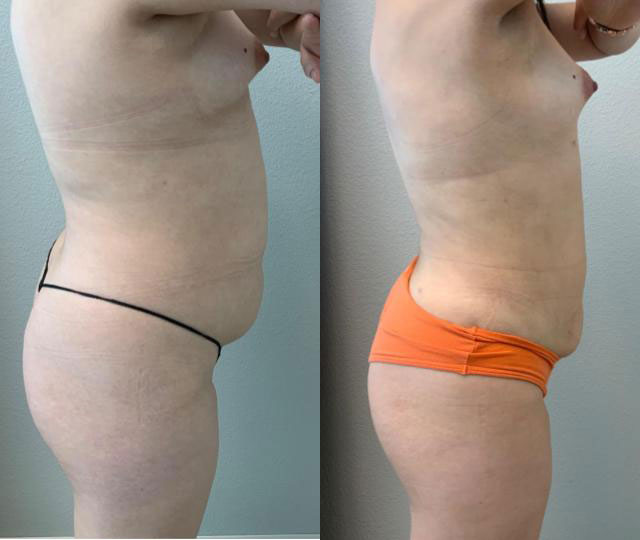Liposuction before and after side view