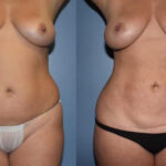 Thumbnail of http://Liposuction%20before%20and%20after%20front%20view