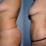 Thumbnail of http://Liposuction%20before%20and%20after%20side%20view