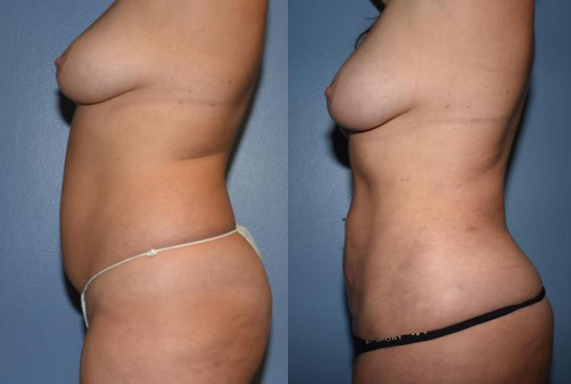 Liposuction before and after side view