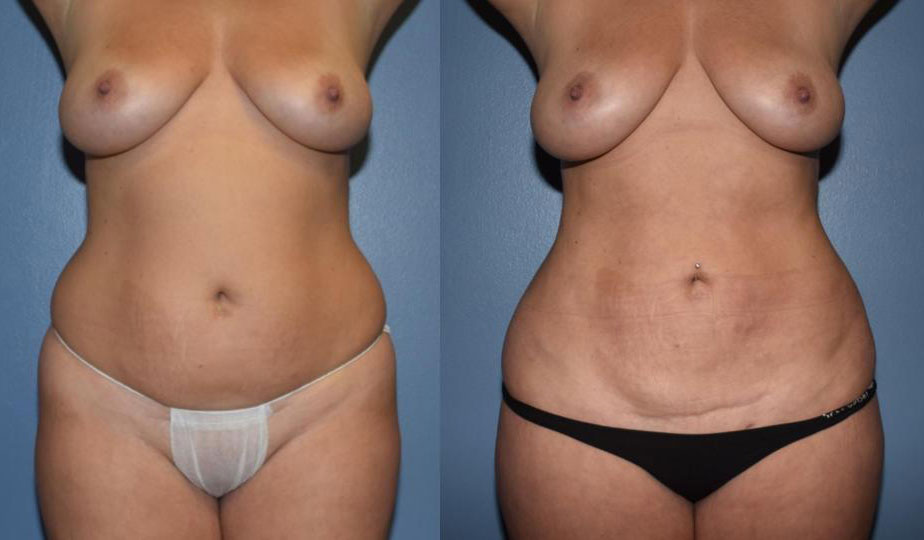 Liposuction before and after front view