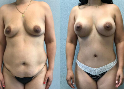 Mommy Makeover Patient 1