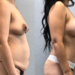 Thumbnail of http://Dr%20Curtis%20Mommy%20Makeover%20Surgery%20before%20and%20after%20results%20side%20view