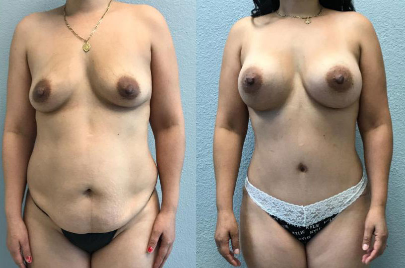 Dr Curtis Mommy Makeover Surgery before and after results