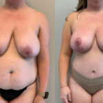 Thumbnail of http://Dr%20Curtis%20Mommy%20Makeover%20before%20and%20after