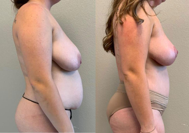 Dr Curtis Mommy Makeover before and after side view