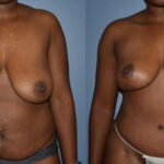 Thumbnail of http://Dr%20Curtis%20Mommy%20Makeover%20before%20and%20after