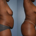 Thumbnail of http://Dr%20Curtis%20Mommy%20Makeover%20before%20and%20after%20side%20view