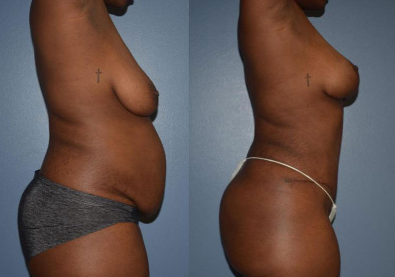 Dr Curtis Mommy Makeover before and after side view