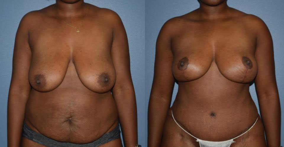 Dr Curtis Mommy Makeover before and after
