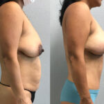 Thumbnail of http://Dr%20Curtis%20Mommy%20Makeover%20before%20and%20after%20side%20view