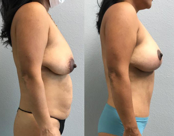 Dr Curtis Mommy Makeover before and after side view