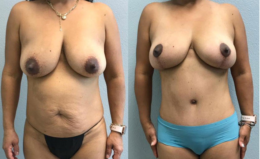 Dr Curtis Mommy Makeover before and after