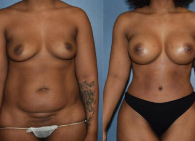 Mommy Makeover Patient 5
