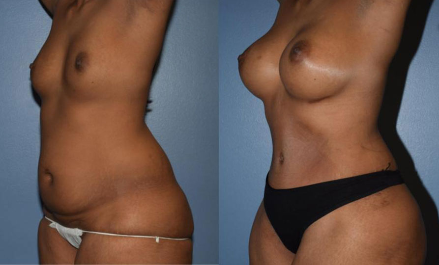 Dr Curtis Mommy Makeover before and after side view