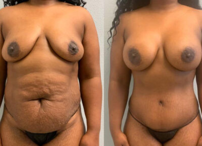 Mommy Makeover Patient 6