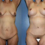 Thumbnail of http://Dr%20Curtis%20Mommy%20Makeover%20before%20and%20after