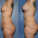 Thumbnail of http://Dr%20Curtis%20Mommy%20Makeover%20before%20and%20after%20side%20view
