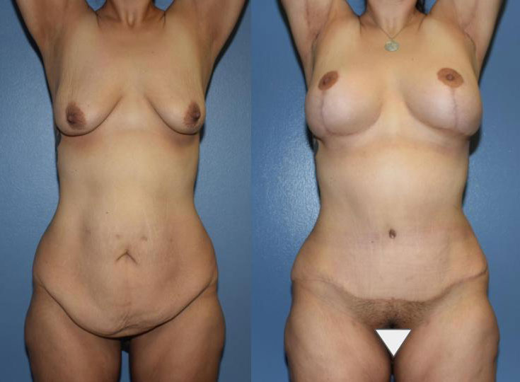 Dr Curtis Mommy Makeover before and after