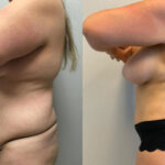 Thumbnail of http://Dr%20Curtis%20Mommy%20Makeover%20before%20and%20after%20side%20view