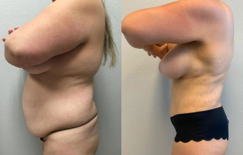 Dr Curtis Mommy Makeover before and after side view