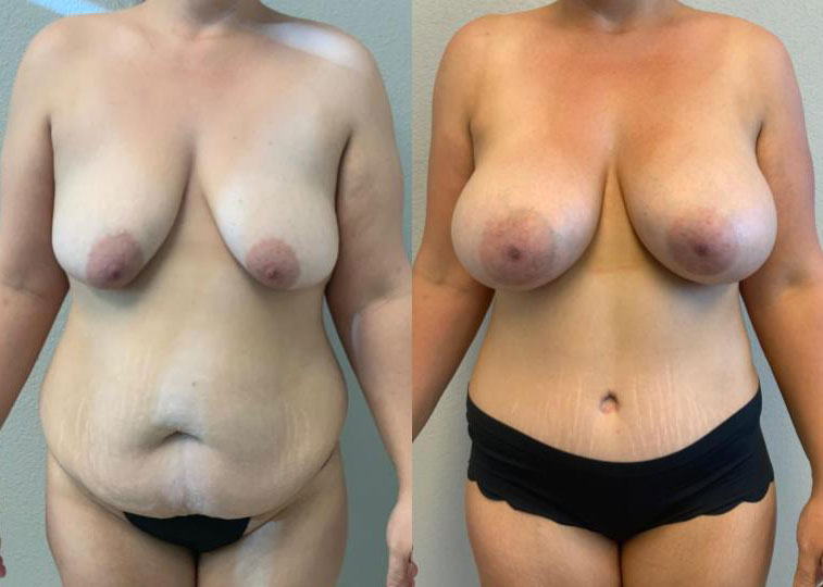 Dr Curtis Mommy Makeover before and after