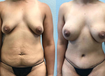 Mommy Makeover Patient 9