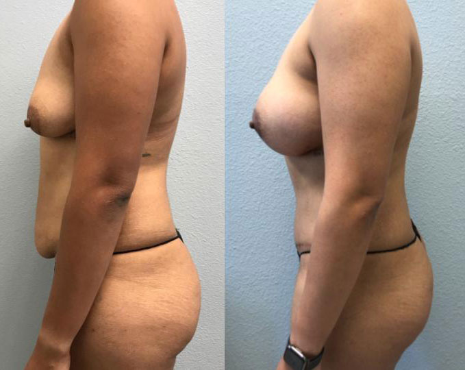 Dr Curtis Mommy Makeover before and after side view