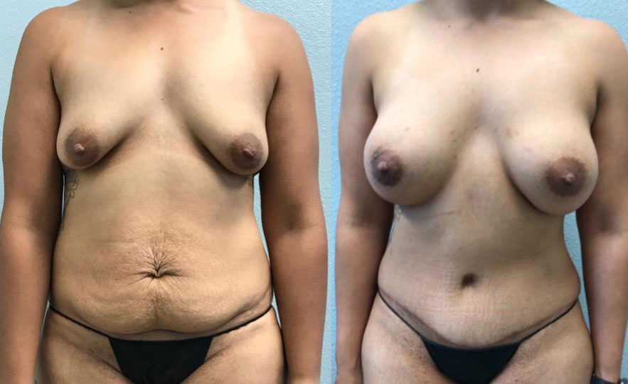 Dr Curtis Mommy Makeover before and after