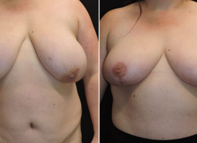 Breast reduction and breast lift patient 14