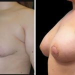Thumbnail of http://breast%20reconstruction%20before%20and%20after%20side%20view