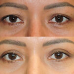 Thumbnail of http://Blepharoplasty%20eyelids%20Dr.%20Zeiderman