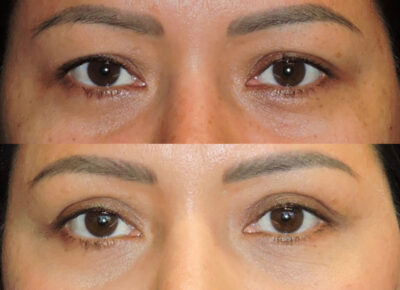 Blepharoplasty Dr. Zeiderman Patient 3