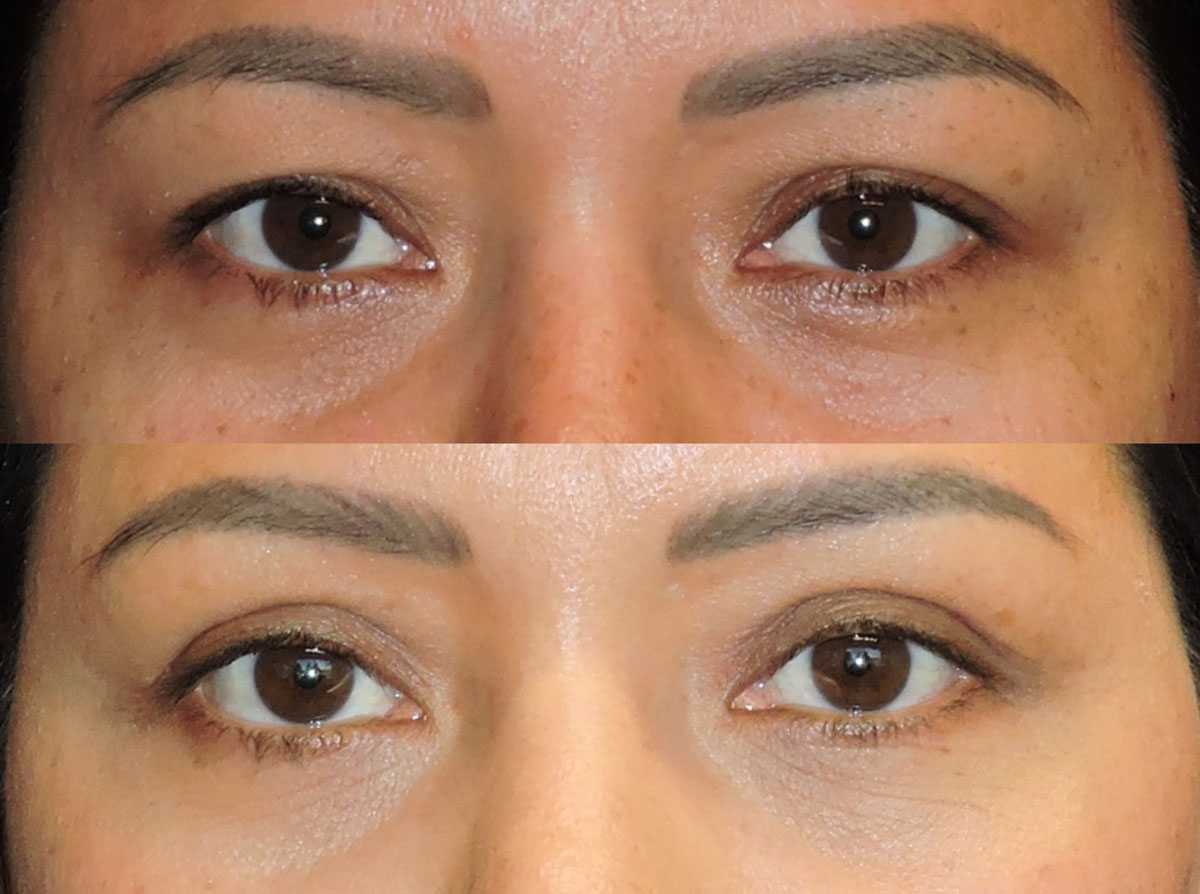 Blepharoplasty eyelids Dr. Zeiderman