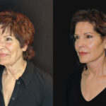 Thumbnail of http://face%20and%20neck%20lift