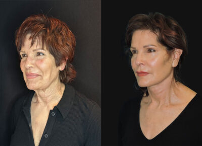 Facelift and Necklift – Zeiderman Patient 3