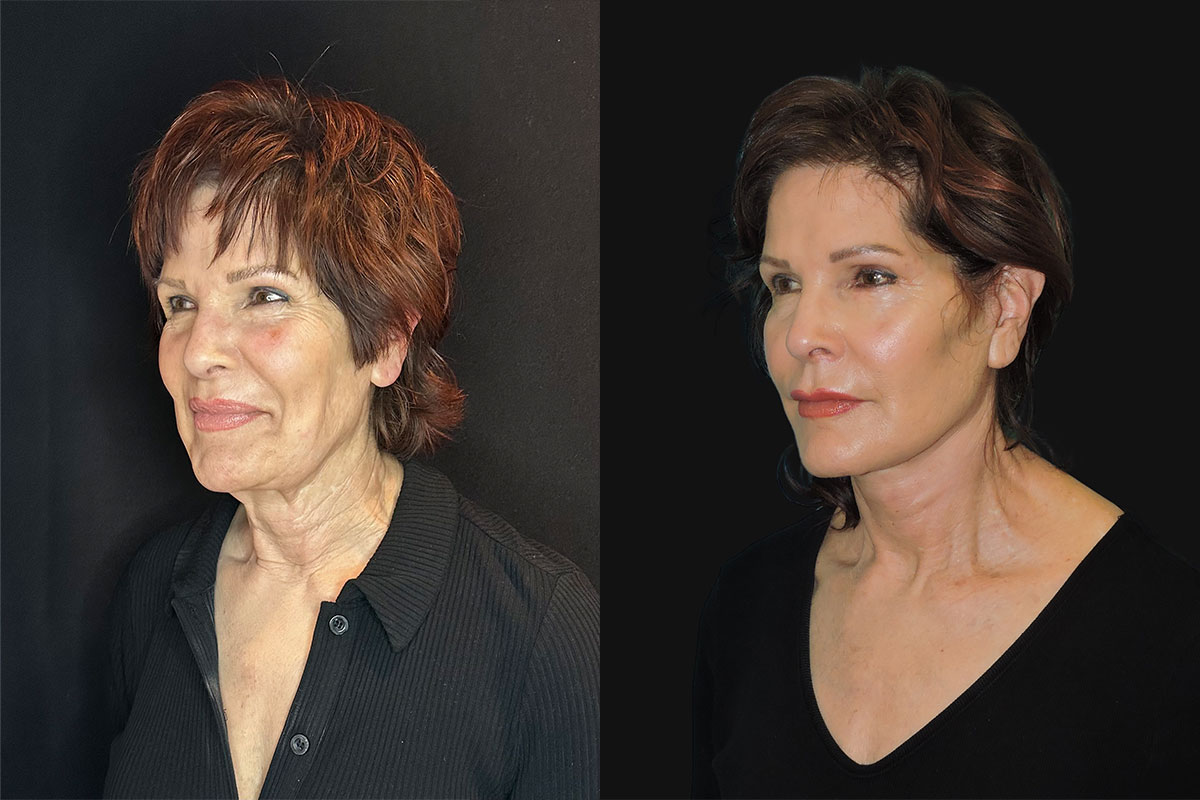 face and neck lift
