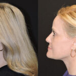 Thumbnail of http://facelift%20and%20necklift%20before%20and%20after