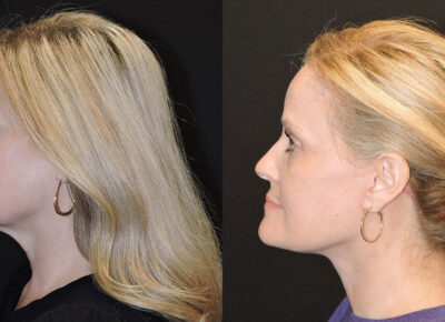 Facelift and Necklift – Zeiderman Patient 4