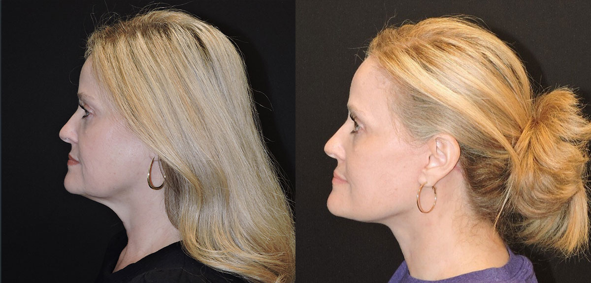 facelift and necklift before and after