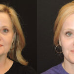 Thumbnail of http://facelift%20and%20necklift%20before%20and%20after