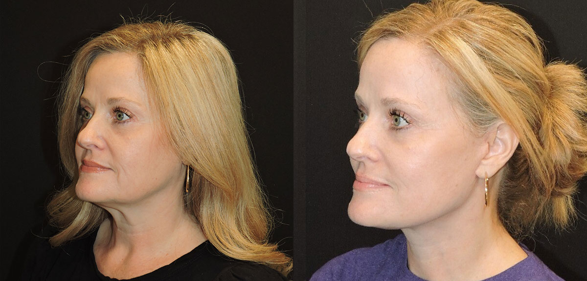 facelift and necklift before and after